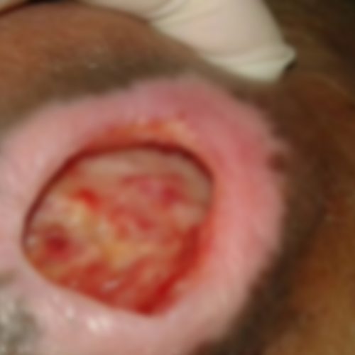 แผลกดทับเบลอ