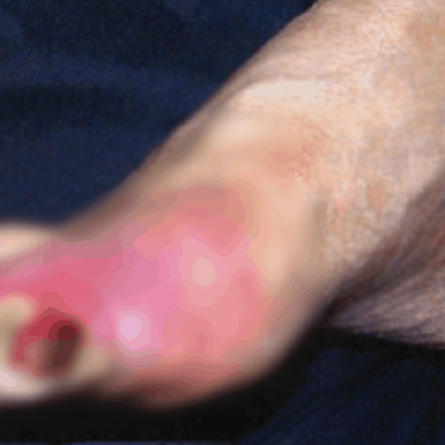 รักษาเบาหวานอย่างไร-ให้ห่างไกลแผลติดเชื้อ_